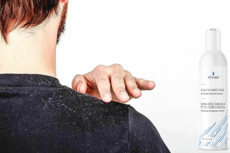 Leczenie łupieżu pstrego – jak pozbyć się problemu z głowy